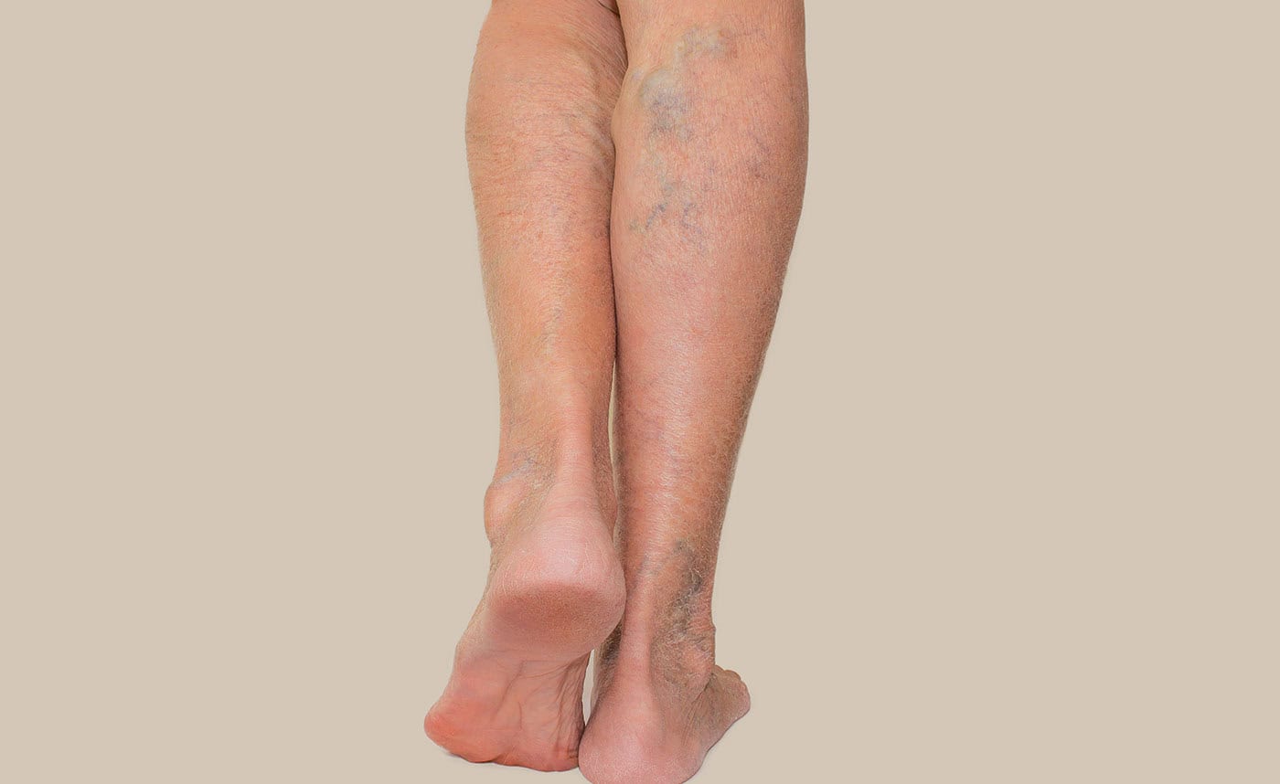 VEIN DISEASE SM